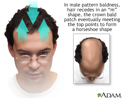 Male Pattern Baldness| Cole Hair Transplant